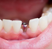 patient smiling with dental implant in mouth 