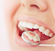 Nose-to-chin view of someone’s teeth reflected in dental mirror