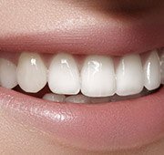 Closeup of teeth following dental bonding