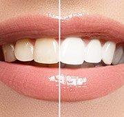 Closeup of smile half before and half after teeth whitening