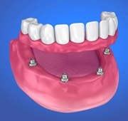 Animated dental implant denture