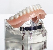 Dental implant denture model