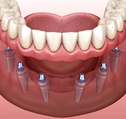Digital image of an implant-retained denture, complete with 6 dental implants