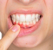 inflamed gum tissue before periodontal treatment