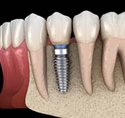 single dental implant in the jawbone
