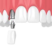 dental implant, abutment, and crown being placed in the upper jaw