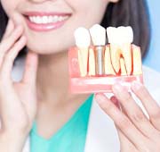 dentist holding a dental implant model