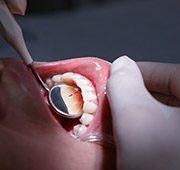 Closeup of smile during dental exam after tooth colored filling placement