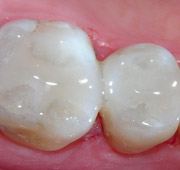Flawless teeth after tooth colored filling placement