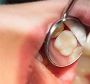 Dentist using dental mirror to show tooth-colored filling