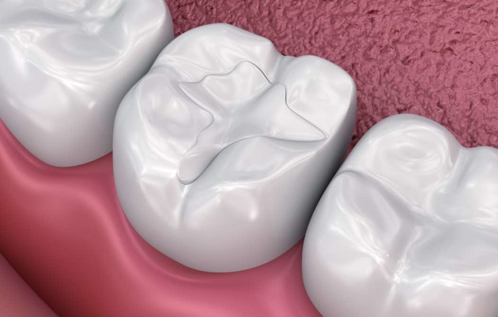 How Do Dental Fillings Work and Do They Ever Need To Be Replaced?