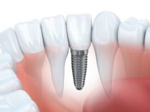 Image of a dental implant replacing a front tooth 