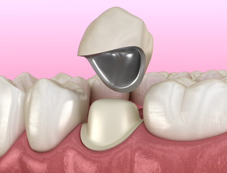 What Are Dental Crowns Made Out Of?