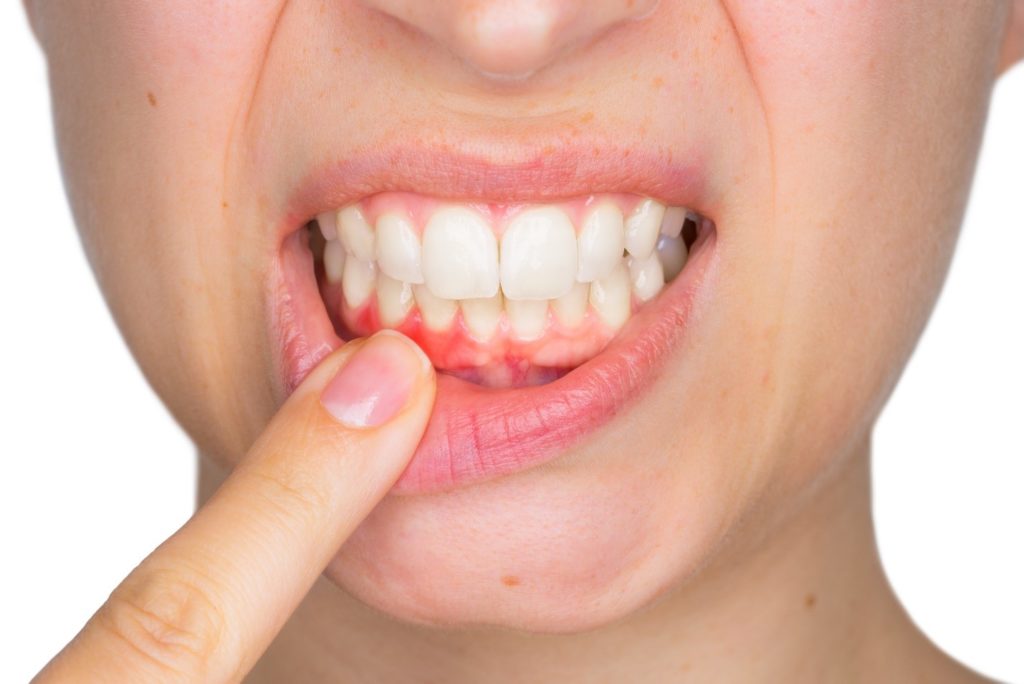 pathological fear of gums pathological fear of gums