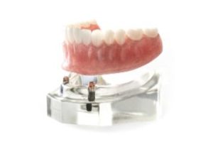 Lower denture supported by dental implants 