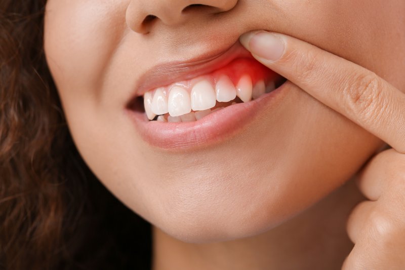 woman exposing red, inflamed gums