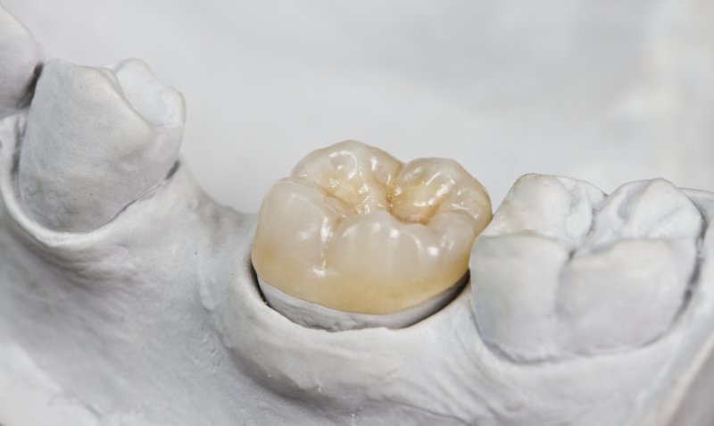 a dental crown