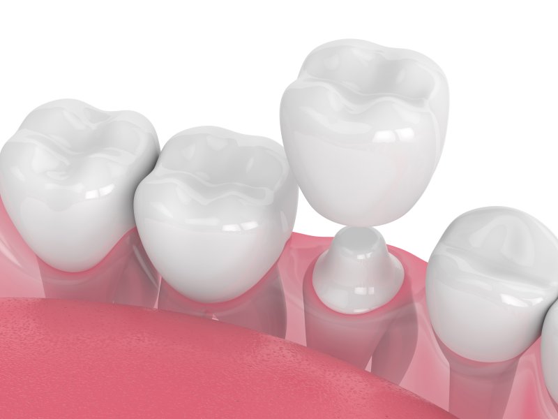 a digital illustration of a dental crown