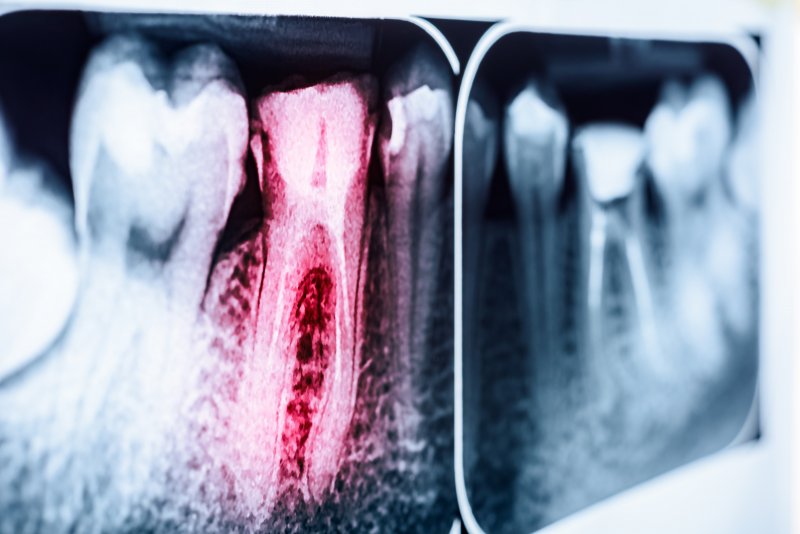 an X ray that shows a root canal