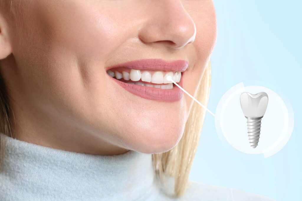 Nose-to-neck view of blond woman smiling with one tooth indicated as implant